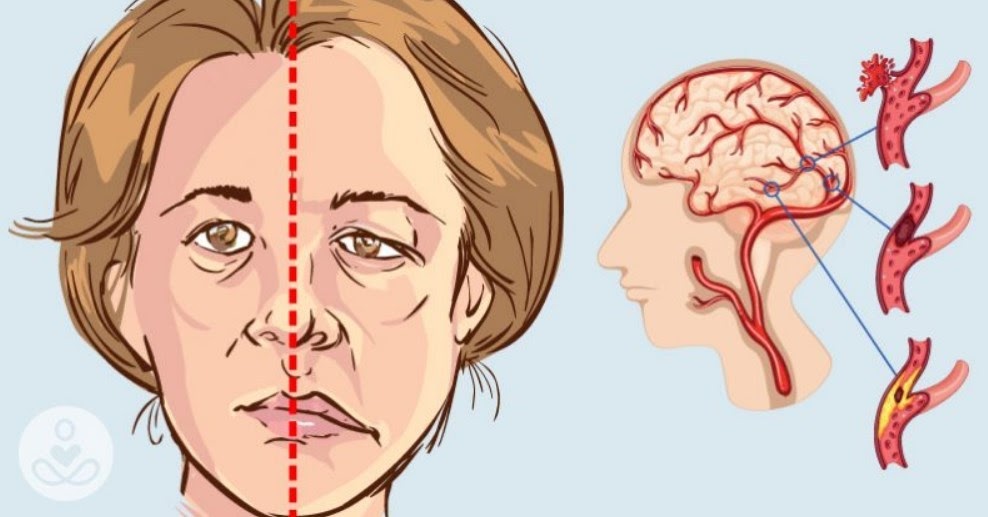 stroke